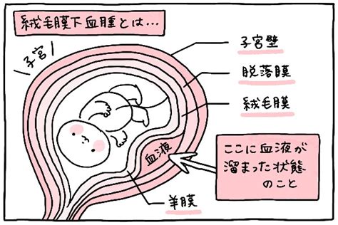 胎盤形成出血|【医師監修】妊娠中に出血を伴う症状、絨毛膜下血腫。